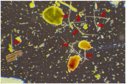 Damaged residential cladding